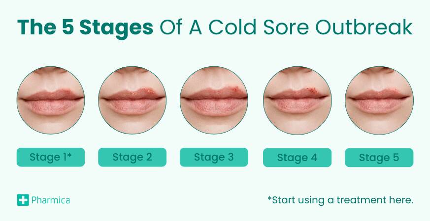 Cold Sores HSV 1 Stages Treatments And Prevention